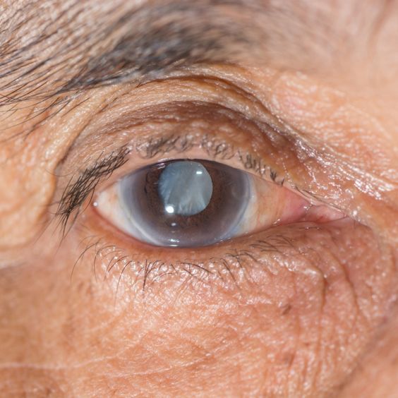 Cataracts: Signs, Symptoms and Treatment Options